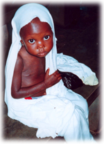 photo d'un enfant malnutri