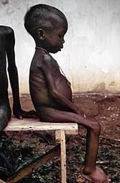 Photo d'un enfant atteint de Kwashiorkor