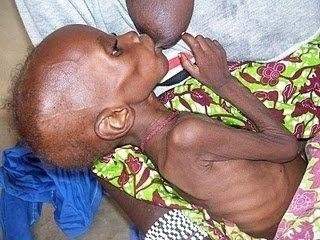 Photo d'un enfant malnutri en train de téter